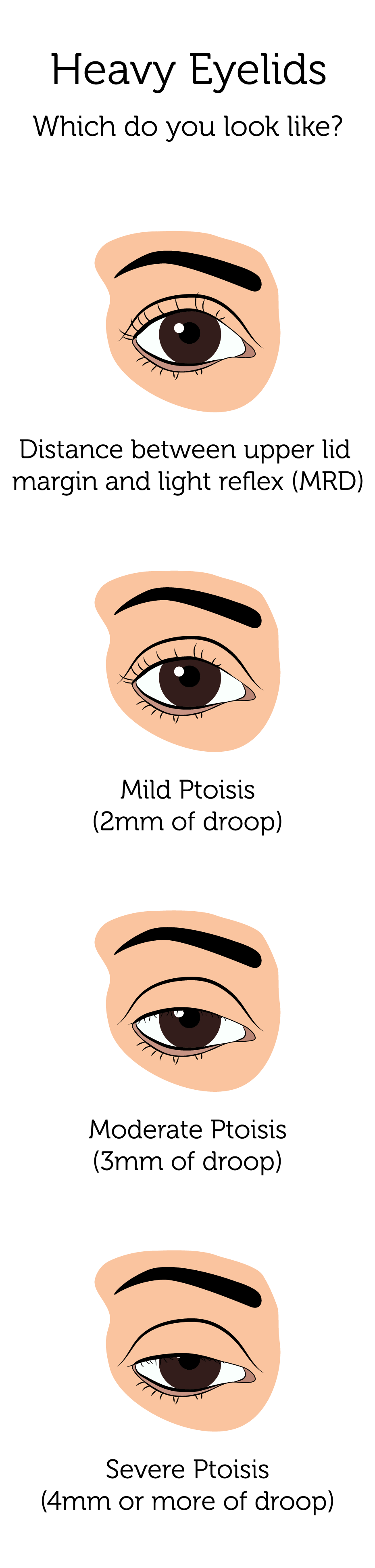 prominent eyelids