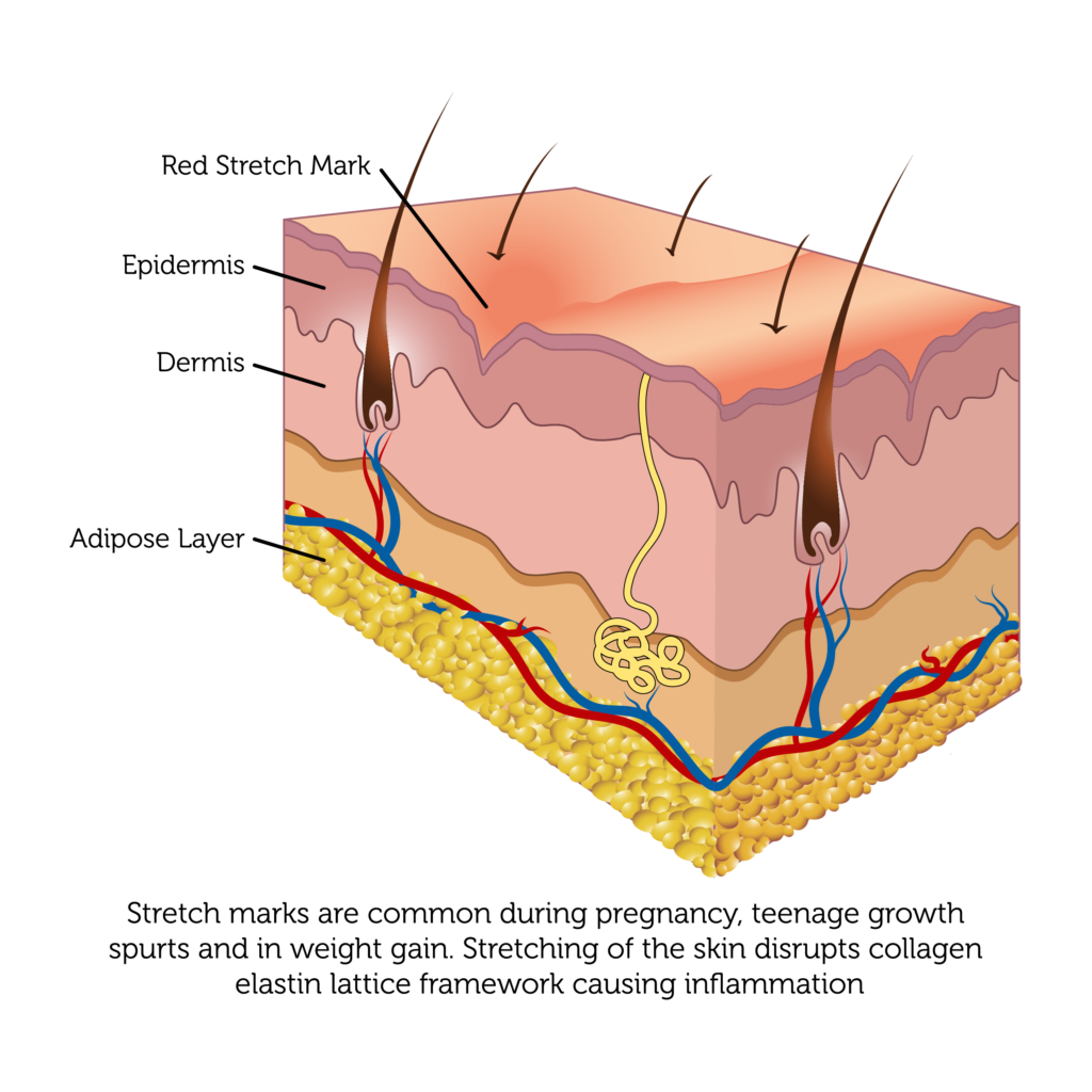 laser-stretch-marks