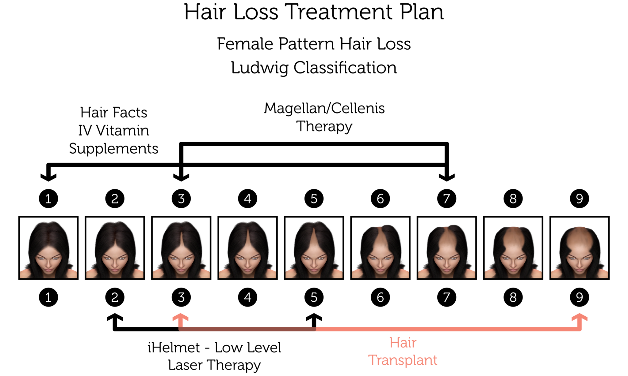 female pattern hair loss