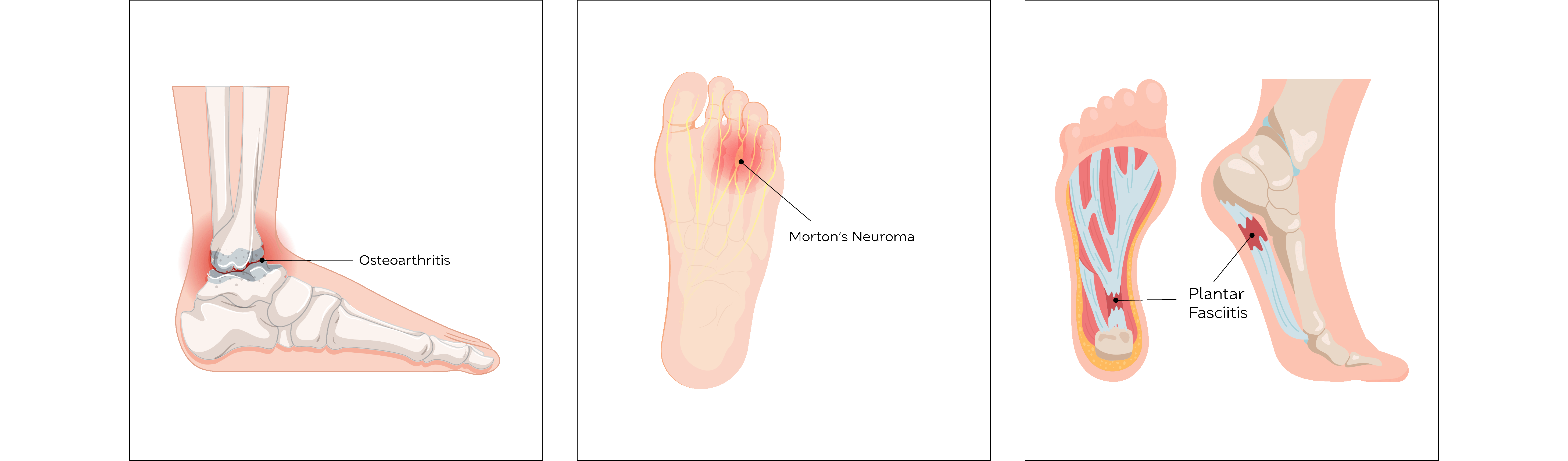 Ankle Foot