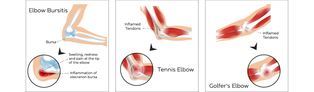 Elbow Anatomy Conditions