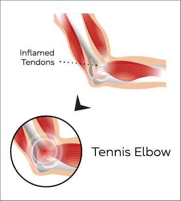 Elbow Anatomy Conditions2