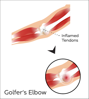 Elbow Anatomy Conditions3