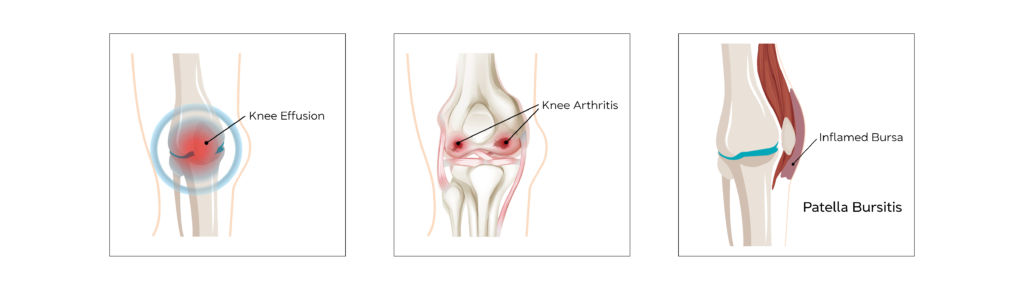 Knee Anatomy Conditions 2