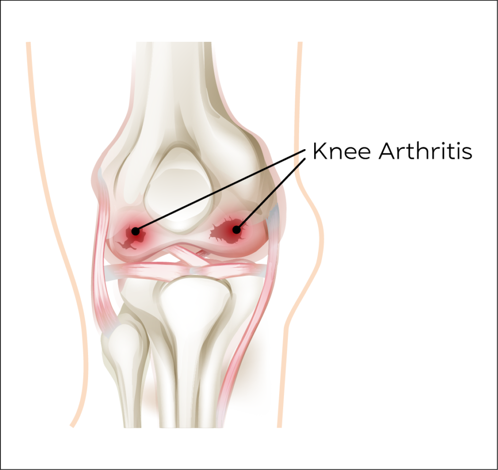 Knee Anatomy Conditions2