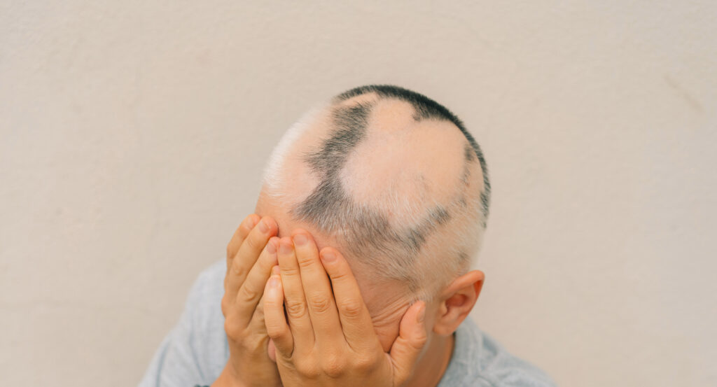 real alopecia areata young girl bald head person diffuse alopecia scaled