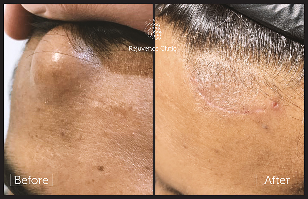 Lipoma before and after 1