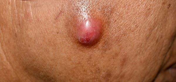 Sebaceous Cyst