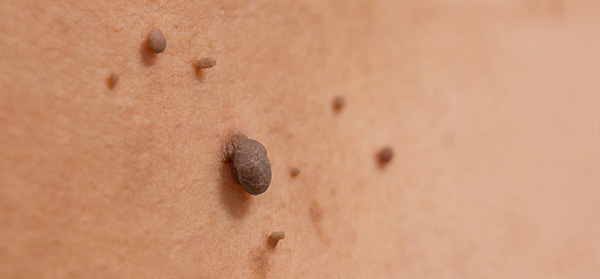 Skin tags