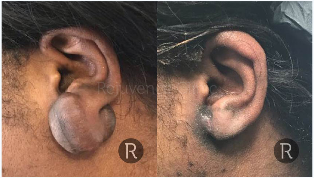 Ear Keloid