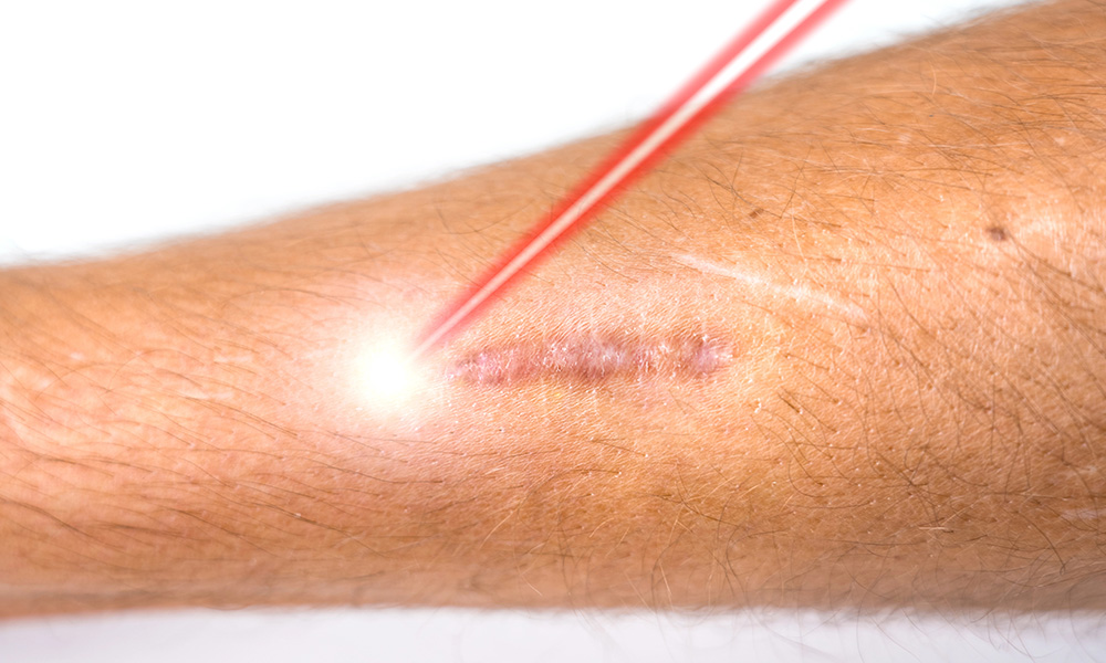 Laser on scars
