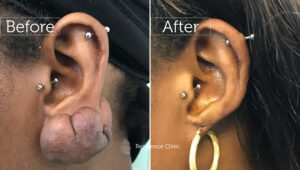 Before and After surgery for the removal of this earlobe keloid with replacement of a new piercing