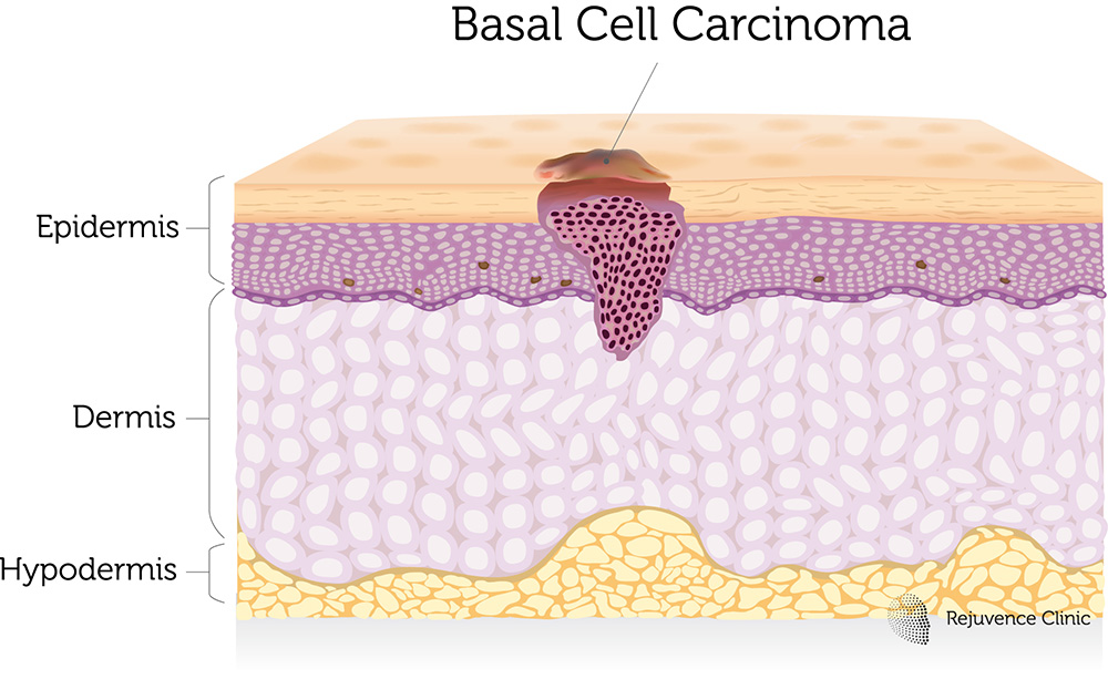 Basal Cell Carcinoma