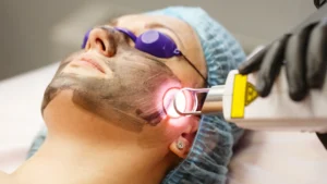 CO2 Laser Treatment for Keloid Scars