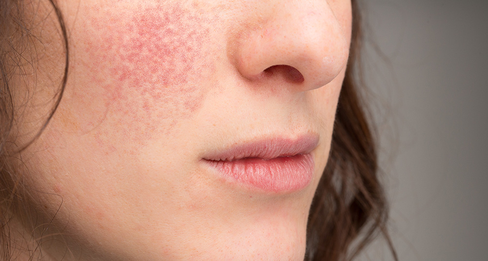 Rosacea