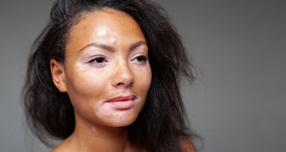 Vitiligo2