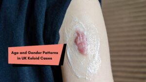Age and Gender Patterns in UK Keloid Cases