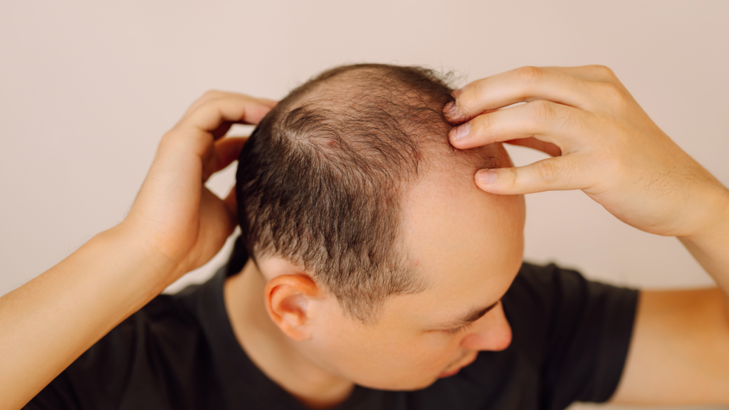 Can PRP Help If Hair Loss Runs in Your Family