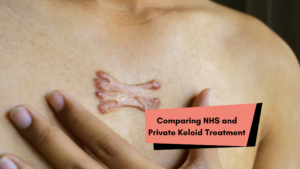 Comparing NHS and Private Keloid Treatment 1