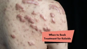 When to Seek Treatment for Keloids