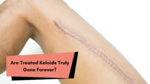 Are Treated Keloids Truly Gone Forever