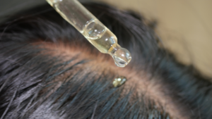 Can PRP Slow Down Progressive Hair Thinning